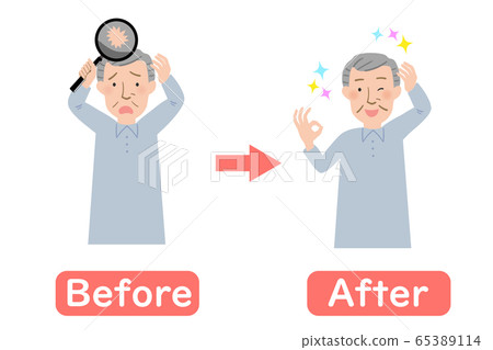 Before and after vector illustration of grandpa suffering from thinning hair Before and after vector illustration of grandpa suffering from thinning hair 65389114