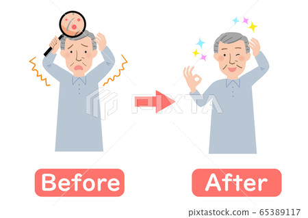 Grandpa's before-after after being concerned about scalp breakouts Grandpa's before-after after being concerned about scalp breakouts 65389117