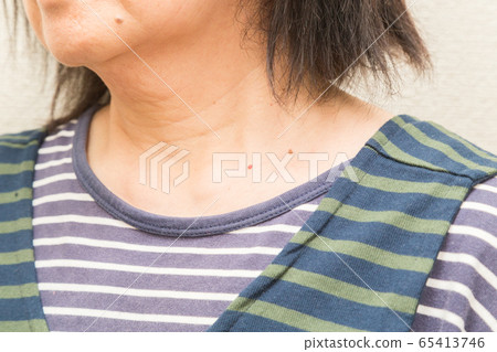 老年性懷孕疣 老年性懷孕疣 65413746