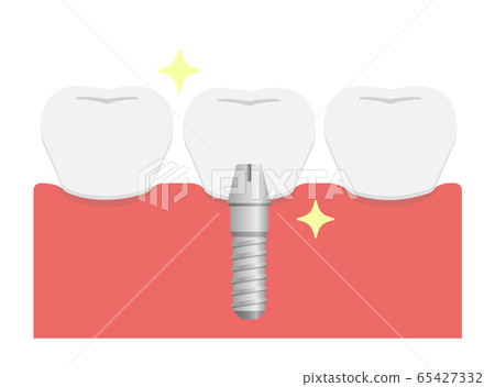 Illustration of implant treatment flow / Implant completion Illustration of implant treatment flow / Implant completion 65427332