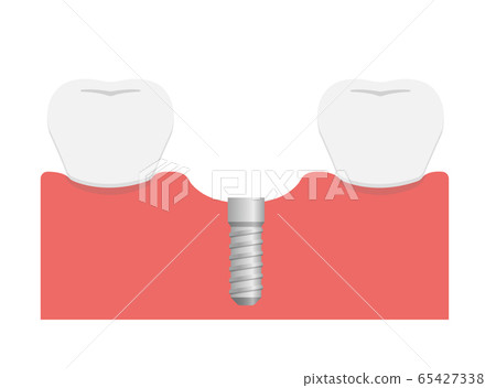 Illustration of implant treatment flow / Embedding fixture Illustration of implant treatment flow / Embedding fixture 65427338