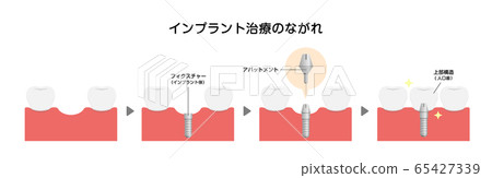 植入物治療流程圖 65427339