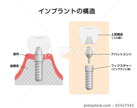 植入物的機理和結構截面圖 65427343