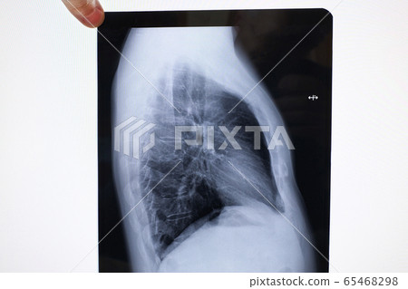 x-ray of lungs of a sick person x-ray of lungs of a sick person 65468298