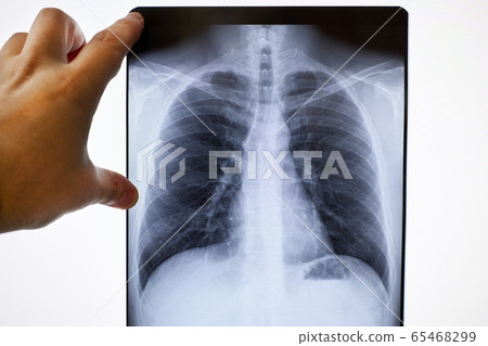 x-ray of lungs of a sick person x-ray of lungs of a sick person 65468299