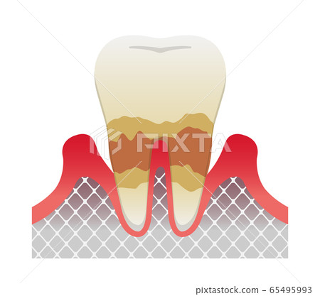 Illustration of stages and symptoms of gingivitis and periodontal disease / Moderate periodontitis 65495993