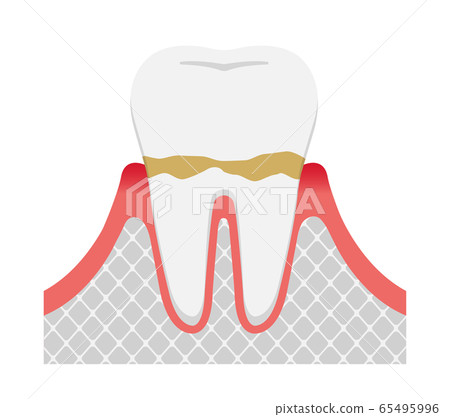 牙齦炎和牙周疾病的階段和症狀的插圖 牙齦炎 插圖素材 圖庫