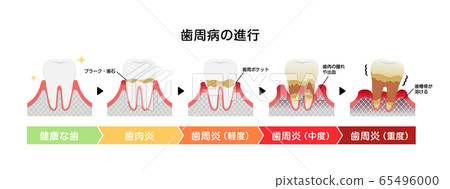 Illustration of stages and symptoms of gingivitis and periodontal disease 65496000