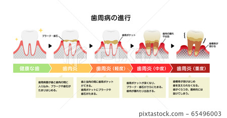 牙齦炎和牙周疾病的階段和症狀說明 65496003