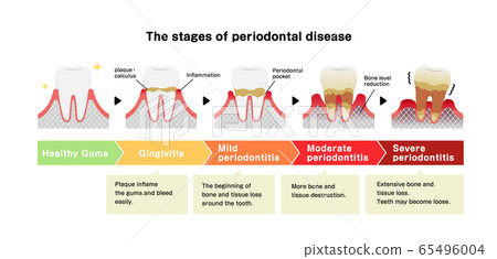 牙齦炎和牙周疾病的階段和症狀插圖 英語 插圖素材 圖庫