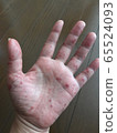 Adult hand-foot-and-mouth disease_hands 65524093
