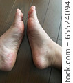 Adult hand-foot-and-mouth disease_foot 65524094