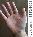 Adult hand-foot-and-mouth disease_hands 65524096
