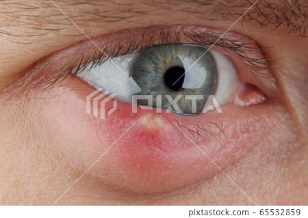 Close up abscess in the eye. hordeolum. stybarley on the eye. inflammation. stye Close up abscess in the eye. hordeolum. stybarley on the eye. inflammation. stye 65532859