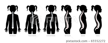 Girl spinal deformity flat vector illustration 65552272
