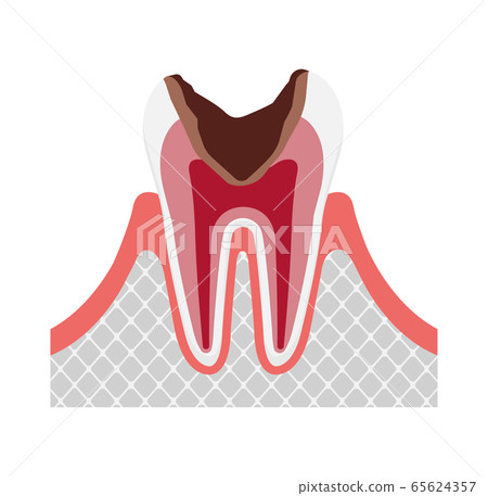 Illustration of caries progression and symptoms / C3, severe caries 65624357