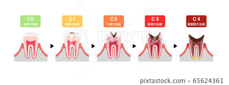 齲病進展和症狀的說明 65624361