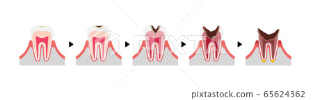齲病進展和症狀說明（無字母） 65624362