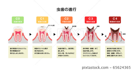 齲齒進展和症狀說明（帶評論） 65624365