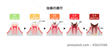 Illustration of caries progression and symptoms 65624366