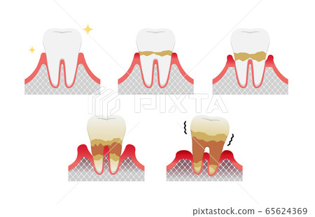 牙齦炎和牙周疾病的階段和症狀插圖集 插圖素材 圖庫