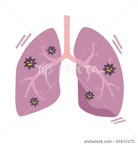 Illustration of lungs with pneumonia caused by a virus. 65635275