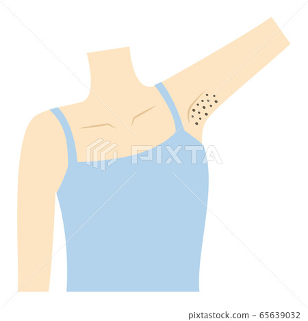 A woman with black armpits, blackheads, ingrown hair A woman with black armpits, blackheads, ingrown hair 65639032