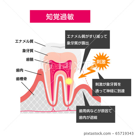 牙齒過敏的原因和機理截面矢量圖 65719343