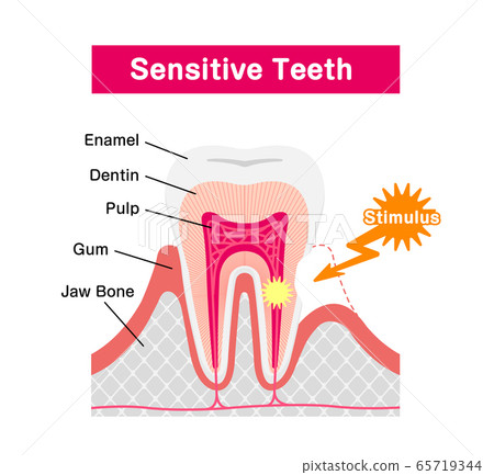 Tooth hypersensitivity Cause and mechanism Cross-section vector illustration / English Tooth hypersensitivity Cause and mechanism Cross-section vector illustration / English 65719344