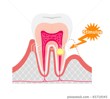 牙齒過敏的原因和機理橫截面矢量圖/英語 65719345