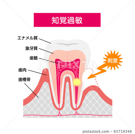Tooth hypersensitivity Cause and mechanism Cross-section vector illustration Tooth hypersensitivity Cause and mechanism Cross-section vector illustration 65719348