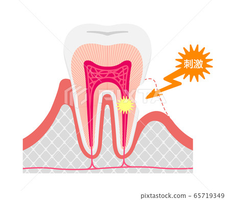 牙齒過敏的原因和機理截面矢量圖 65719349