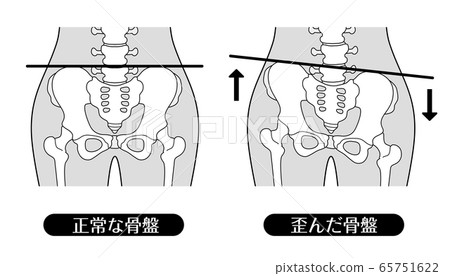 Normal pelvis and distorted pelvis monochrome - Stock Illustration ...