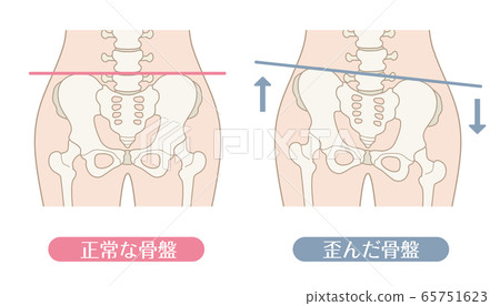 Normal pelvis and distorted pelvis 65751623