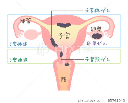 子宫癌 卵巢癌插图 插图 带文字 图库插图