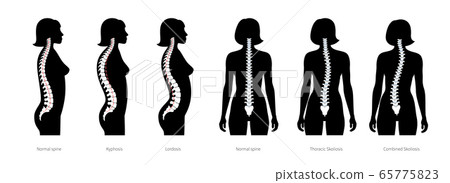 Spinal deformity flat vector illustration 65775823