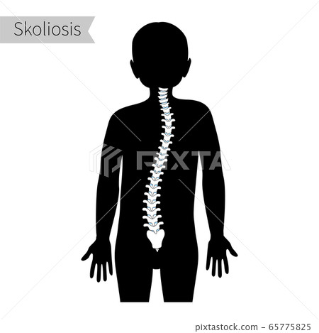Scoliosis flat vector illustration Scoliosis flat vector illustration 65775825