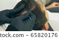 High quality close-up of a man laying on a couch during the esthetician hair treatment. Male tricopigmentation service. Scalp micropigmentation treatment. Trichopigmentation procedure. 65820176