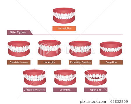 牙齒對齊 牙列 咬合不正的類型矢量插圖集 英語 插圖素材 6529 圖庫