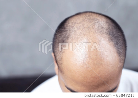 Bald men, hair loss, heavy stress 65847215