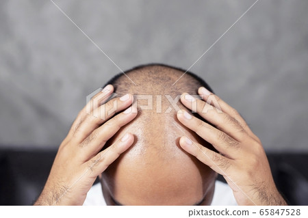 Bald men, hair loss, heavy stress Bald men, hair loss, heavy stress 65847528