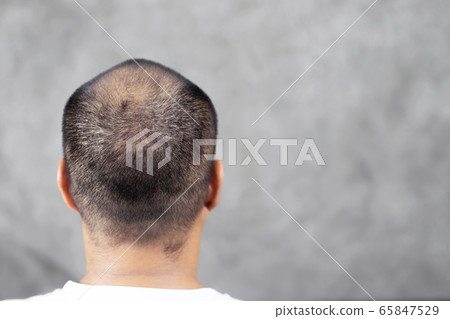 Bald men, hair loss, heavy stress Bald men, hair loss, heavy stress 65847529