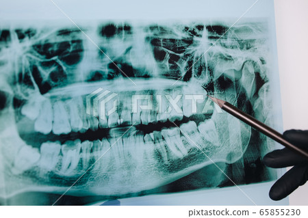 Doctor examining teeth x-ray image, close up Doctor examining teeth x-ray image, close up 65855230