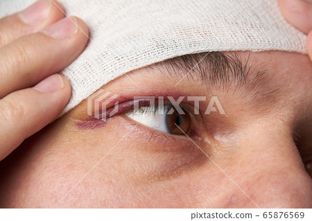 close view of a bruise near the eye, the face of a 65876569