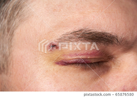 close view of a bruise near the eye, the face of a close view of a bruise near the eye, the face of a 65876580