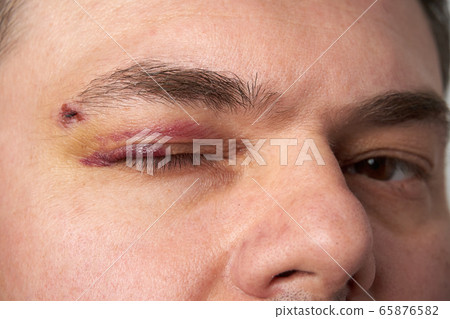 close view of a bruise near the eye, the face of a 65876582