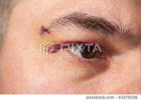 close view of a bruise near the eye, the face of a 65876586