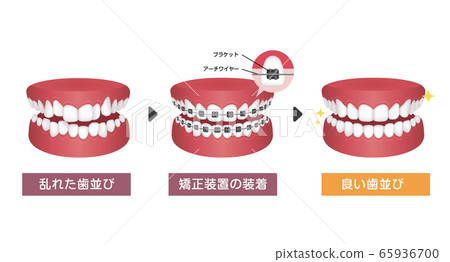 Orthodontics / orthodontics process vector illustration 65936700
