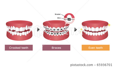 Orthodontics and Orthodontics Process Vector Illustration / English Orthodontics and Orthodontics Process Vector Illustration / English 65936701