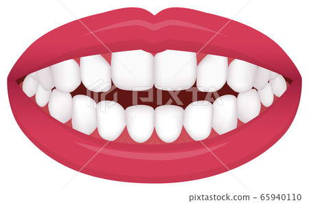 Types of teeth, dentition, malocclusion Vector illustration / Open bite Types of teeth, dentition, malocclusion Vector illustration / Open bite 65940110